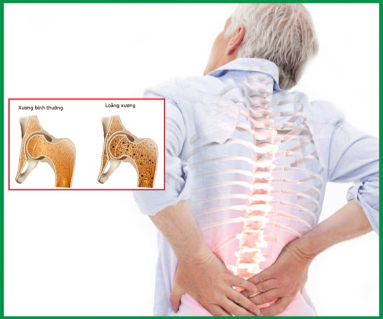 Loãng xương làm cho xương trở nên yếu, giòn, dễ gãy hơn và gây đau lưng dữ dội